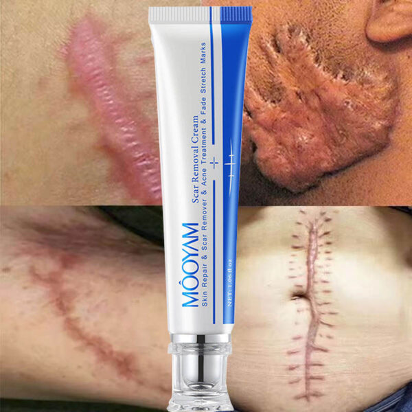 MOOYAM Strong Effective Natural Acne Scar Removal Cream